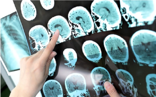 Investigan cómo detectar Alzheimer con inteligencia artificial